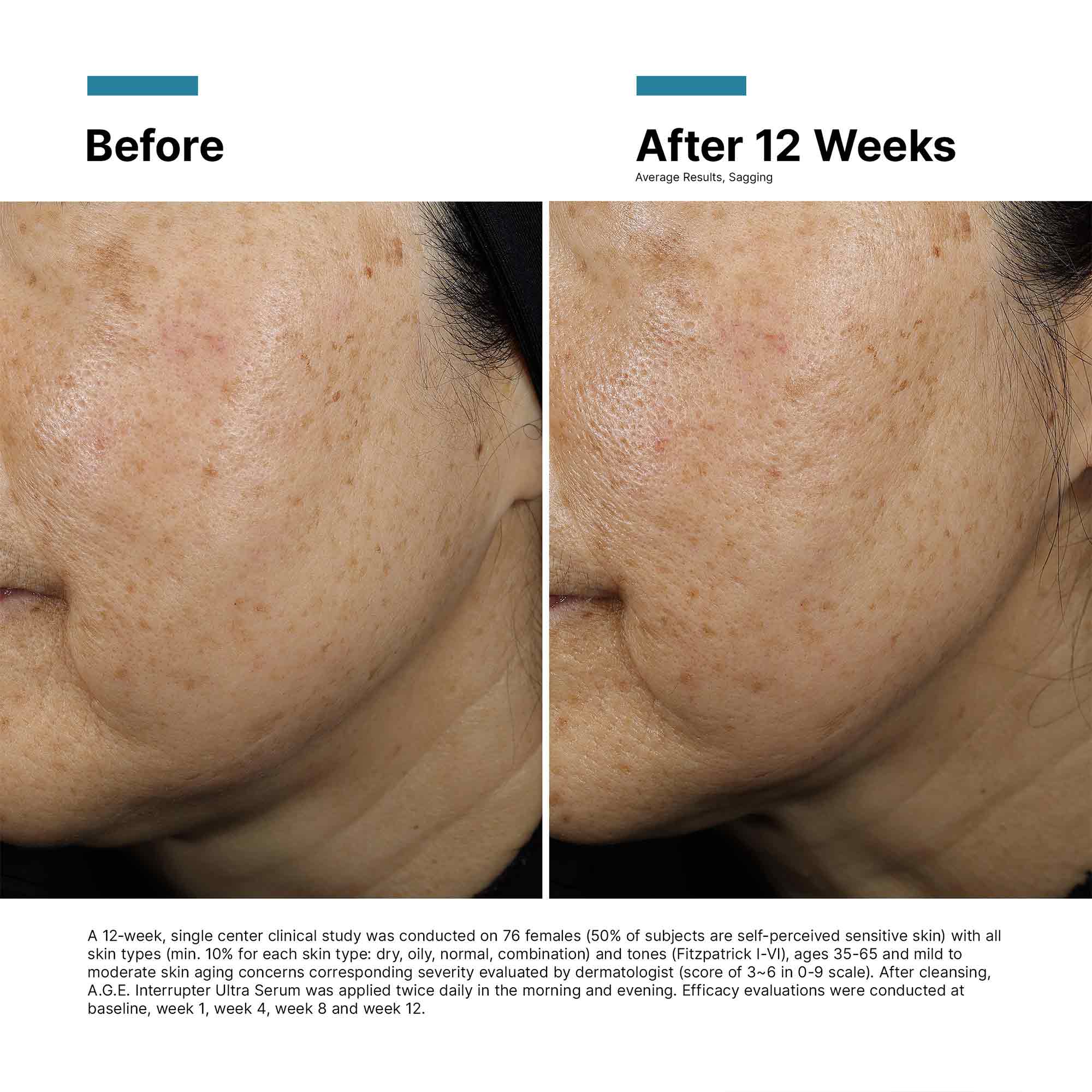 A.G.E. Interrupter Ultra Lifting Serum