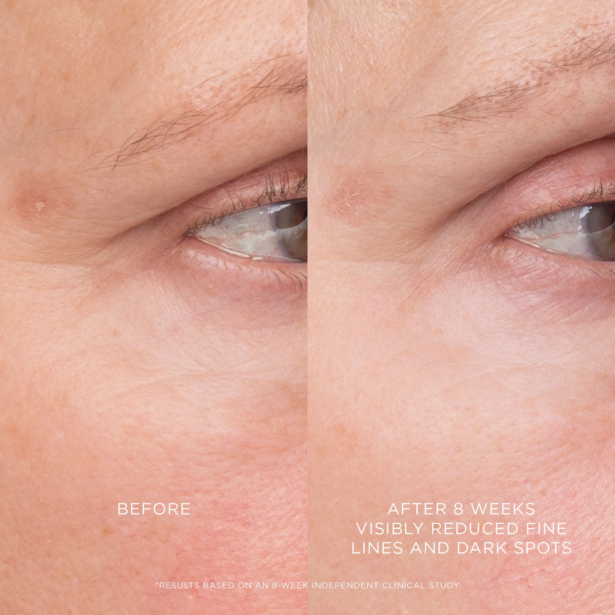 Equilibrium Resurfacing Retinoid Treatment