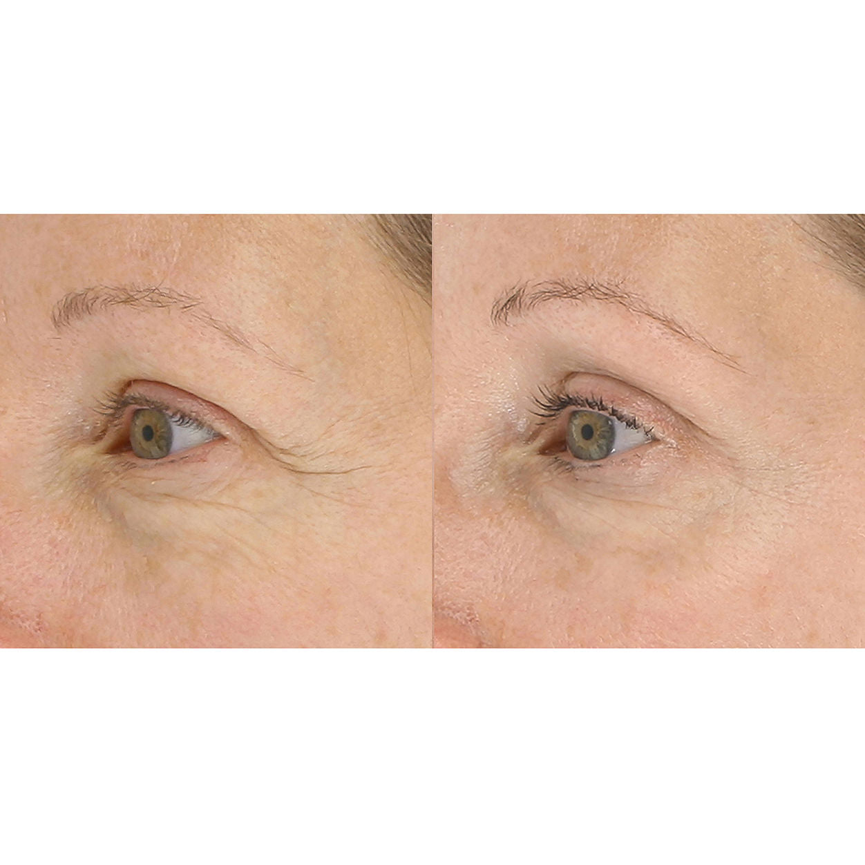 LightStim for Wrinkles