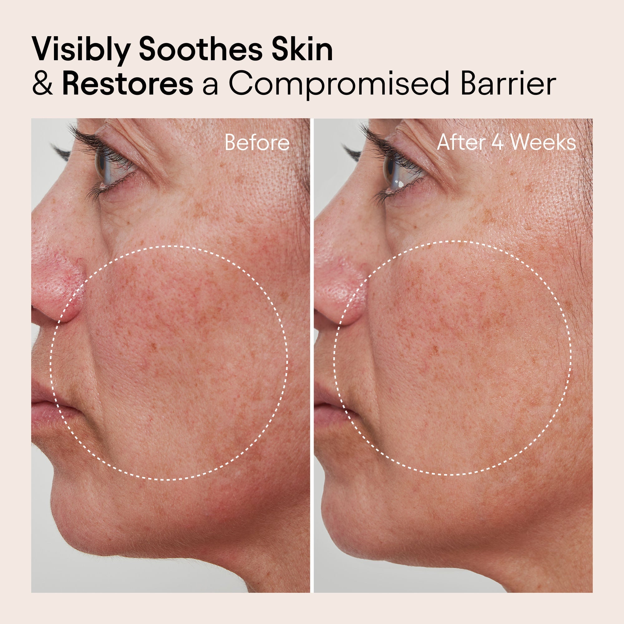 Barrier Repair Cream Moisturizer for Eczema, Wrinkle and Barrier Repair