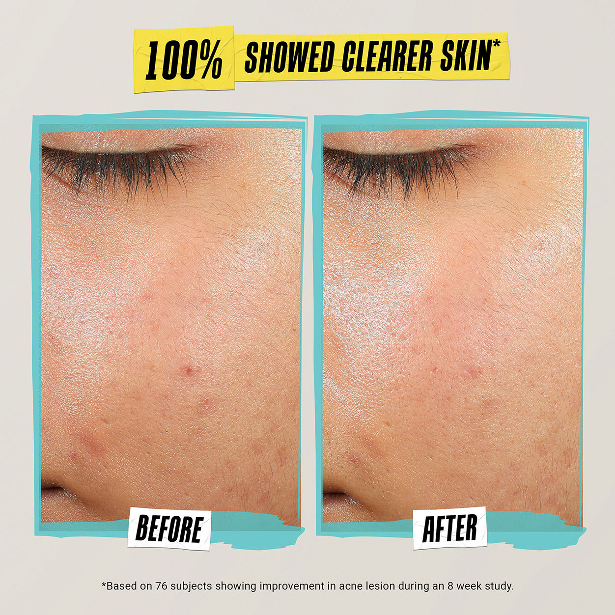 Expertly Clear Acne-Treating & Preventing Lotion