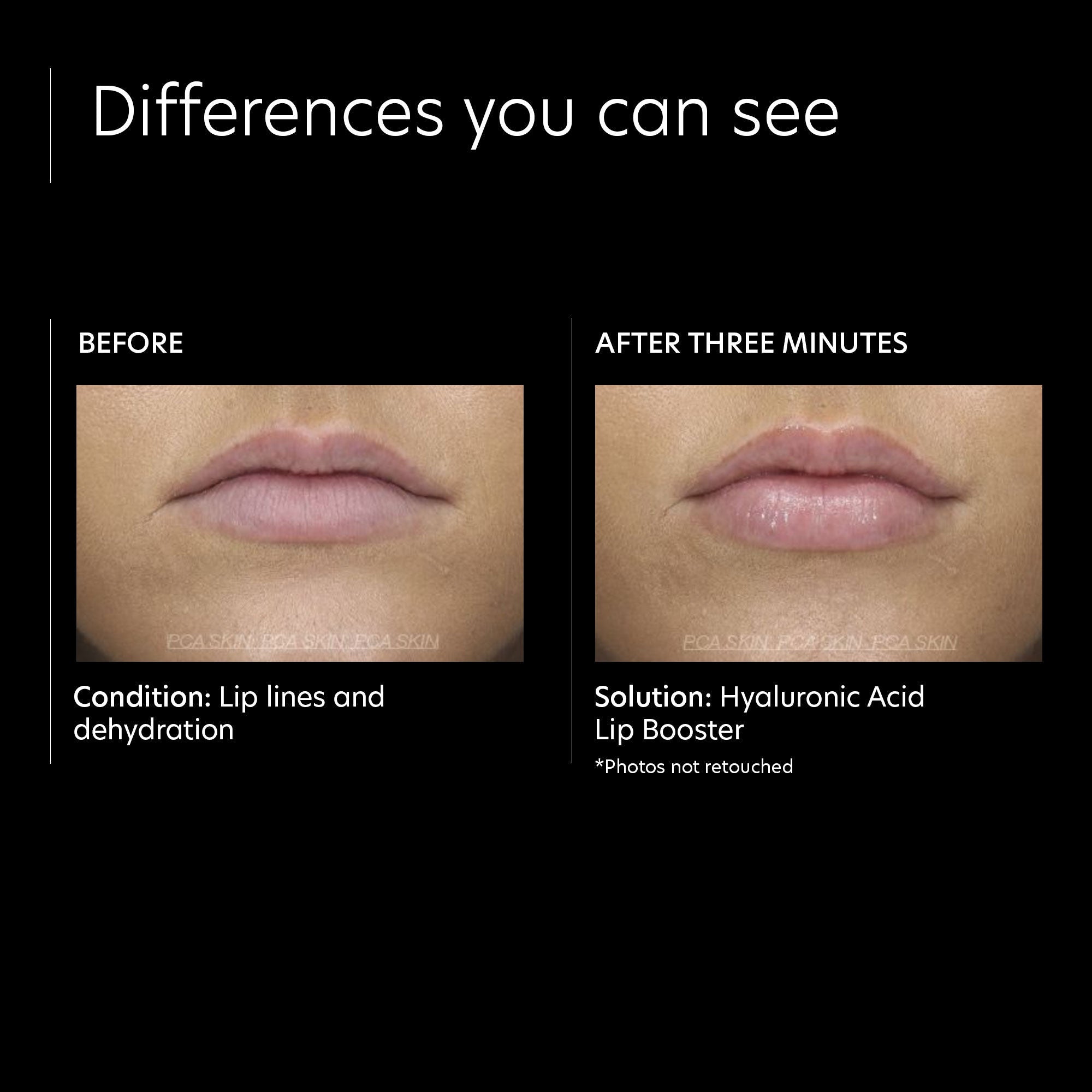 Hyaluronic Acid Lip Booster