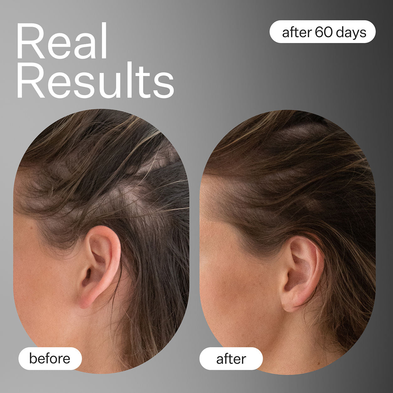 Dermaroller Hair System