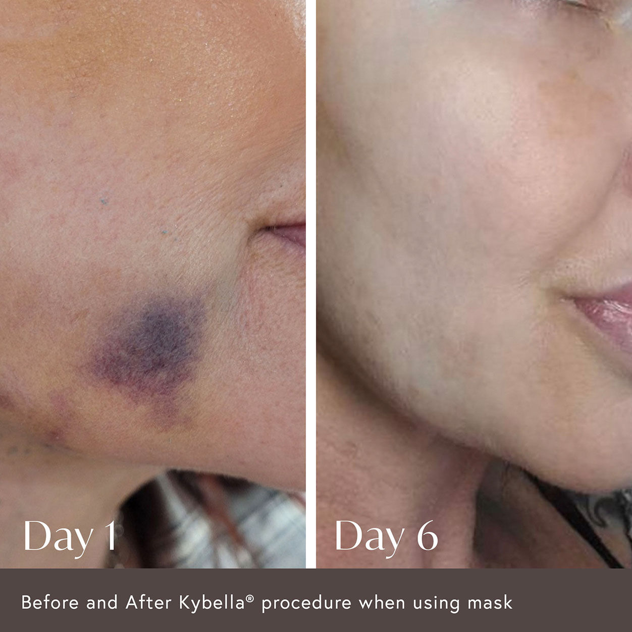 Ciao For Now Post Injection Care Mask